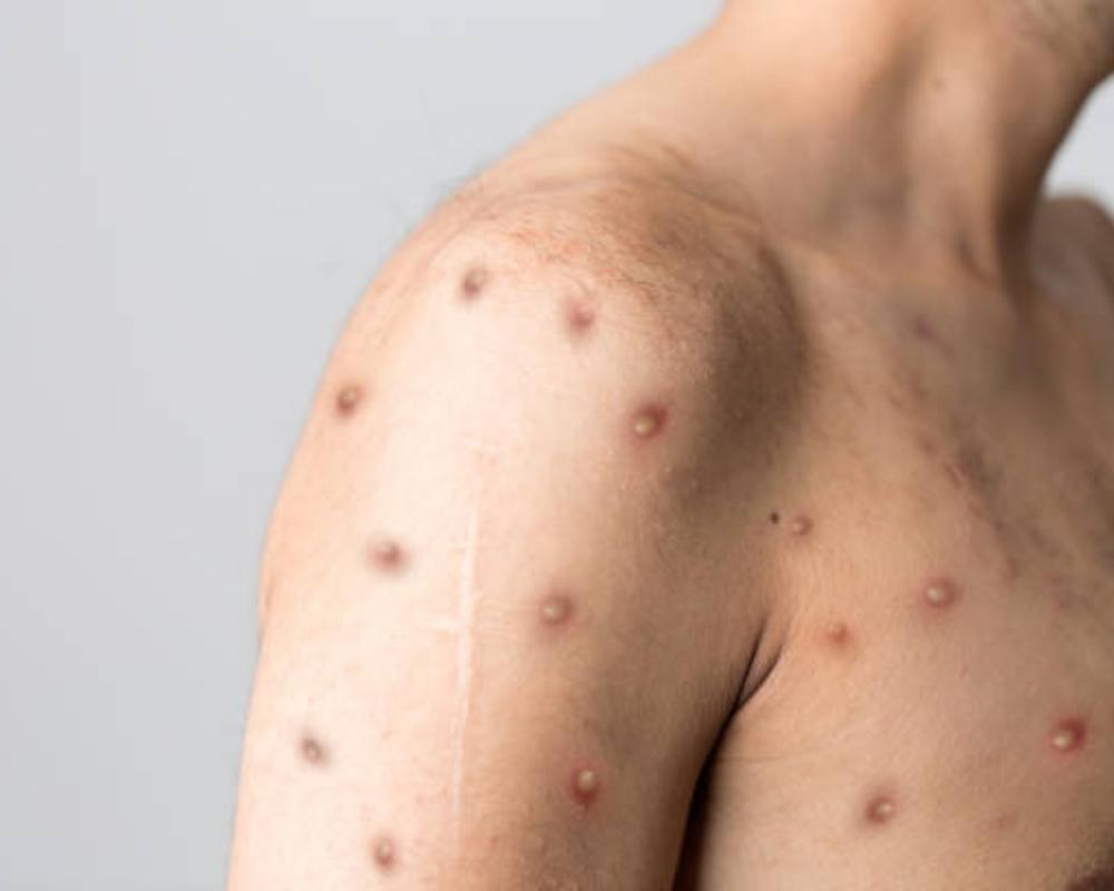 Mpox (Monkeypox): Causes, Symptoms, Treatment & Prevention