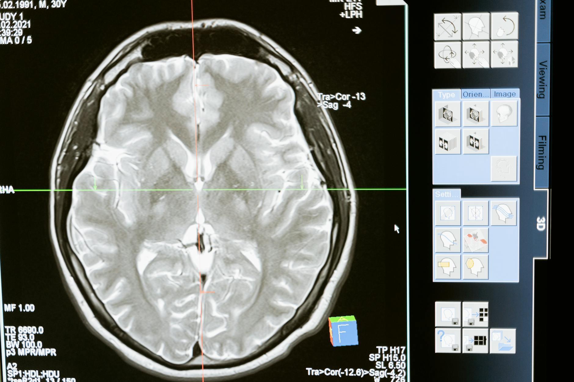 What is Neuroplasticity's Role in Reducing Anxiety?