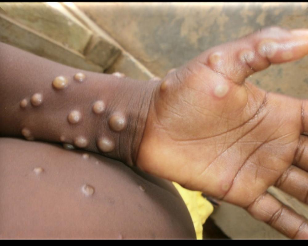 What is mpox?