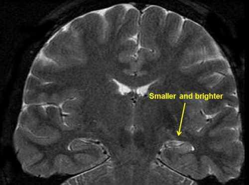 Temporal Lobe Epilepsy Part 1