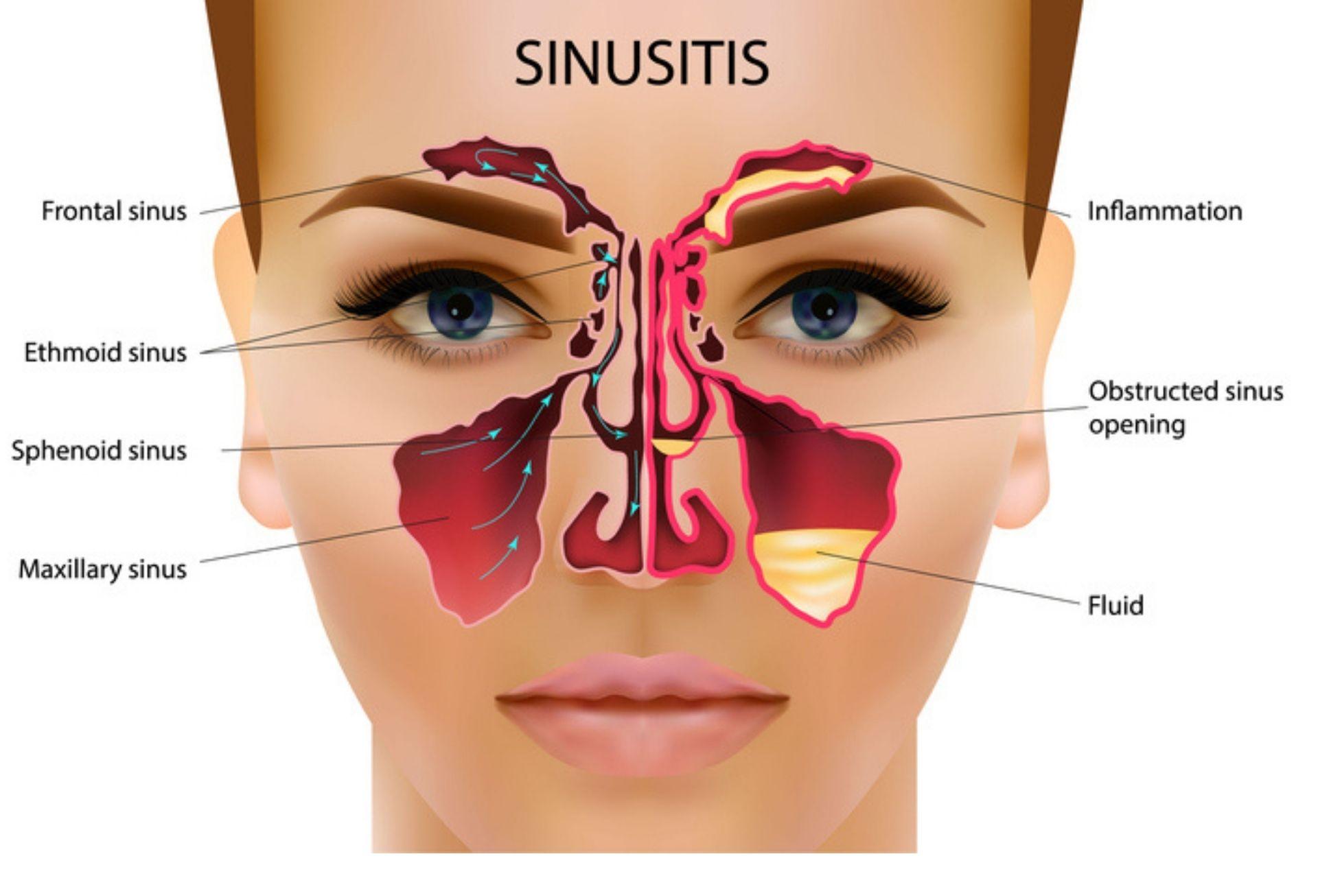 Maxillary sinusitis or an infection of the maxillary sinus