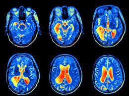 Functional Magnetic Resonance Imaging (fMRI) And How It Works