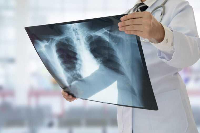 Medical X-rays and cancer