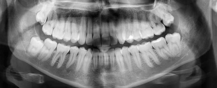 New dental treatment may heal tooth cavities without any filling