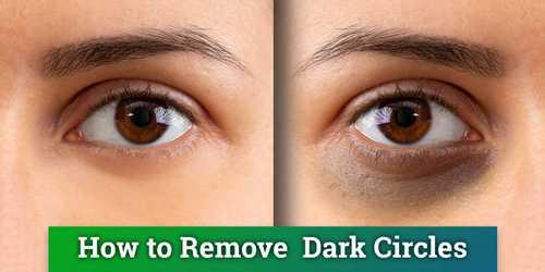Remove dark circles permanently in just 1 week.(best home remedy)