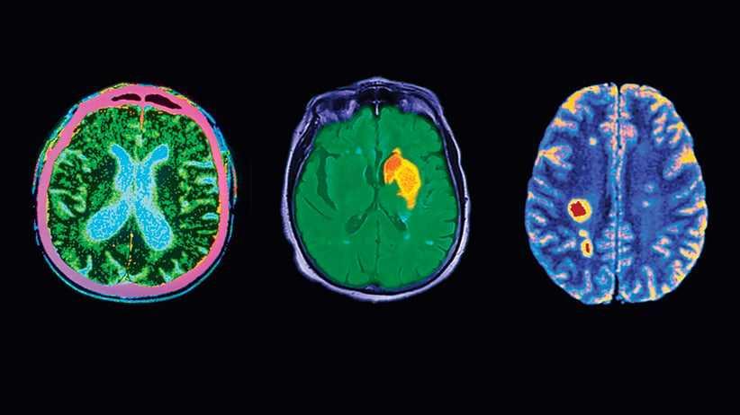 Myth: Brain Damage is Permanent