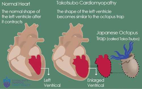 Takotsubo Cardiomyopathy - St Vincent's Heart Health