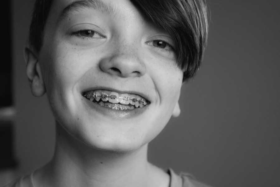 FAQs On Teeth Staining 