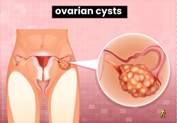 Ayurvedic Treatment for ovarian cyst, causes, and symptoms - FHB