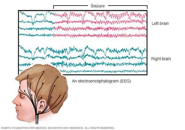 Electroencephalography (EEG)